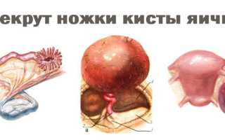 Перекрут ножки кисты яичника