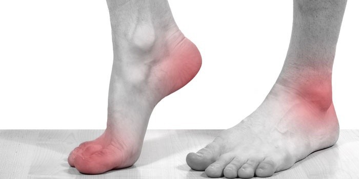 Подагра на ногах