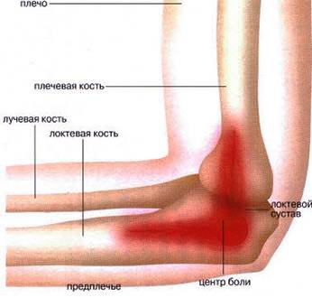 Боли в локте Боли в локтевом суставе