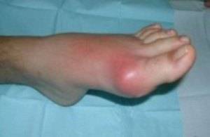 Острый подагрический артрит Острый подагрический артрит