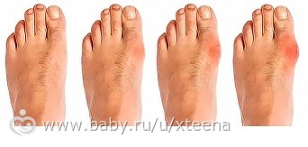 Подагра: Лечение