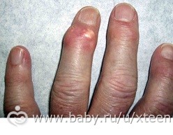 Подагра: Лечение