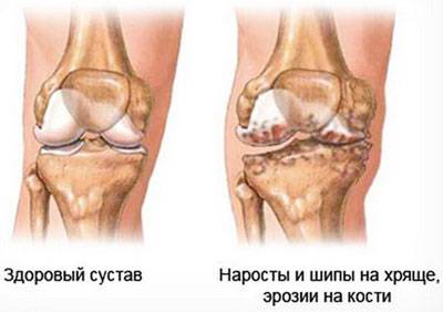Проявление гонартроза коленного сустава Проявление гонартроза коленного сустава