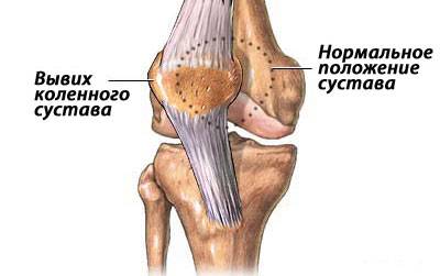 Вывих коленного сустава Вывих коленного сустава
