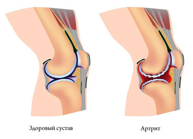 артрит сустава