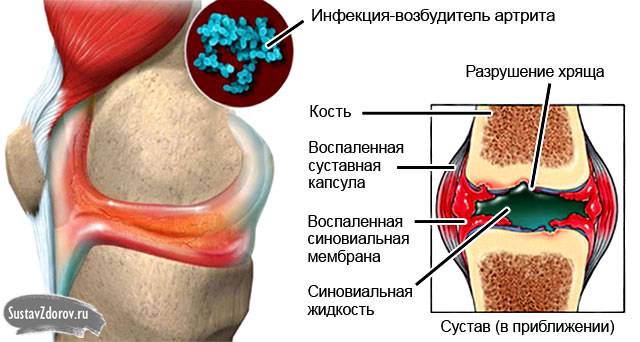 артрит, вызванный инфекцией
