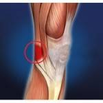 боли под коленкой