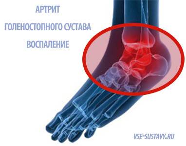воспаление голеностопа при артрите