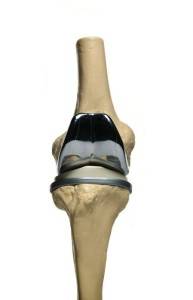 Эндопротез колена Эндопротезирование колена