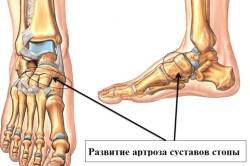 Схема артроза суставов стопы Схема артроза суставов стопы