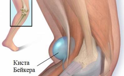 лечение кисты бейкера у детей