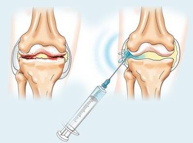 гиалуроновая кислота