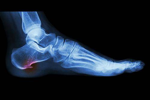 лечение шпоры на пятке лекарства