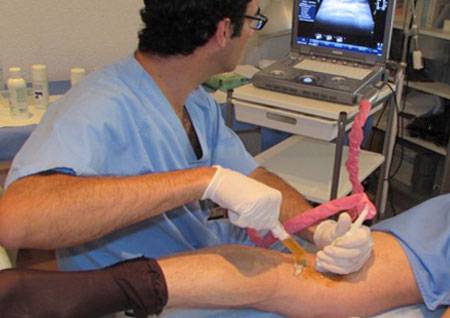 киста беккера операция