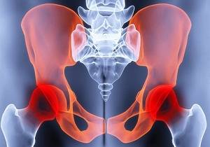 коксартроз тазобедренного сустава симптомы и лечение