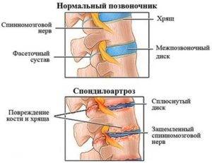 Спондилоартроз Спондилоартроз