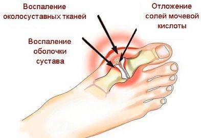 Стопа, на которой показано образование подагры