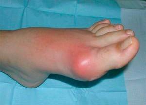 Обострение подагры