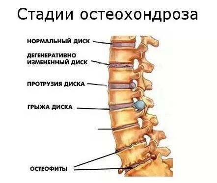 стадии остеохондроза