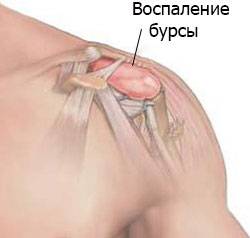Воспаление бурсы