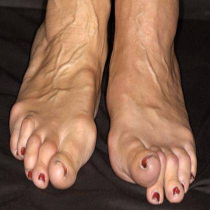 ревматоидный артрит причины