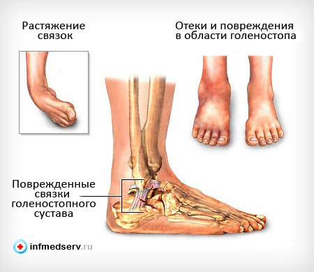 При растяжении связок голеностопного сустава