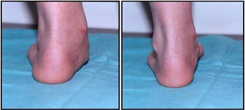 Растяжение связок голеностопа: лечение, как долго заживает, мази4