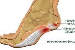 Пяточные шпоры при бурсите Пяточные шпоры при бурсите