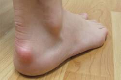 Шишки на пятке - проявление бурсита Шишки на пятке - проявление бурсита