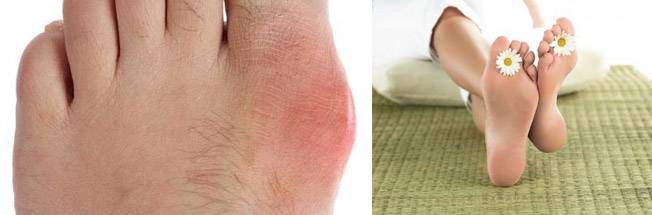 Терапия при подагре