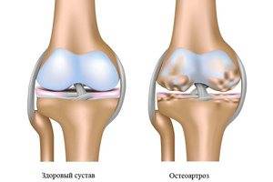 Остеоартроз коленного сустава Остеоартроз коленного сустава