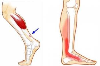 Тендинит это