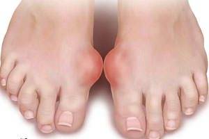 Подагра на ногах Подагра на ногах