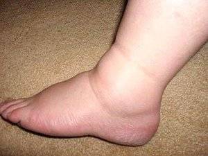 Отек ноги в области голеностопа Отекла нога в области голеностопа