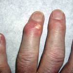 подагра на руках