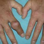 подагра на руках