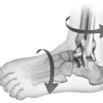 перелом голеностопа