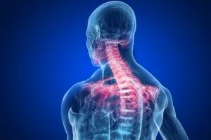 спондилоартроз шейного отдела позвоночника