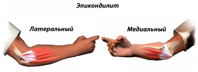 боль в локте причины