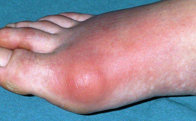 Проявление подагры на ступне Проявление подагры на ступне