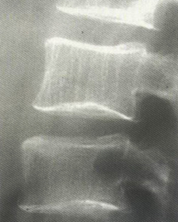 Рентгенограмма позвоночника при остеопорозе. Повышеннная прозрачность, деформация позвонков Рентгенограмма позвоночника при остеопорозе. Повышеннная прозрачность, деформация позвонков