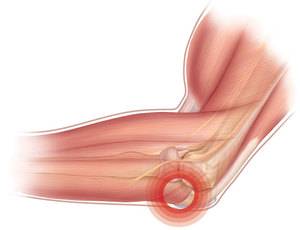 Боли во время разгибания руки Боль в локтевом суставе