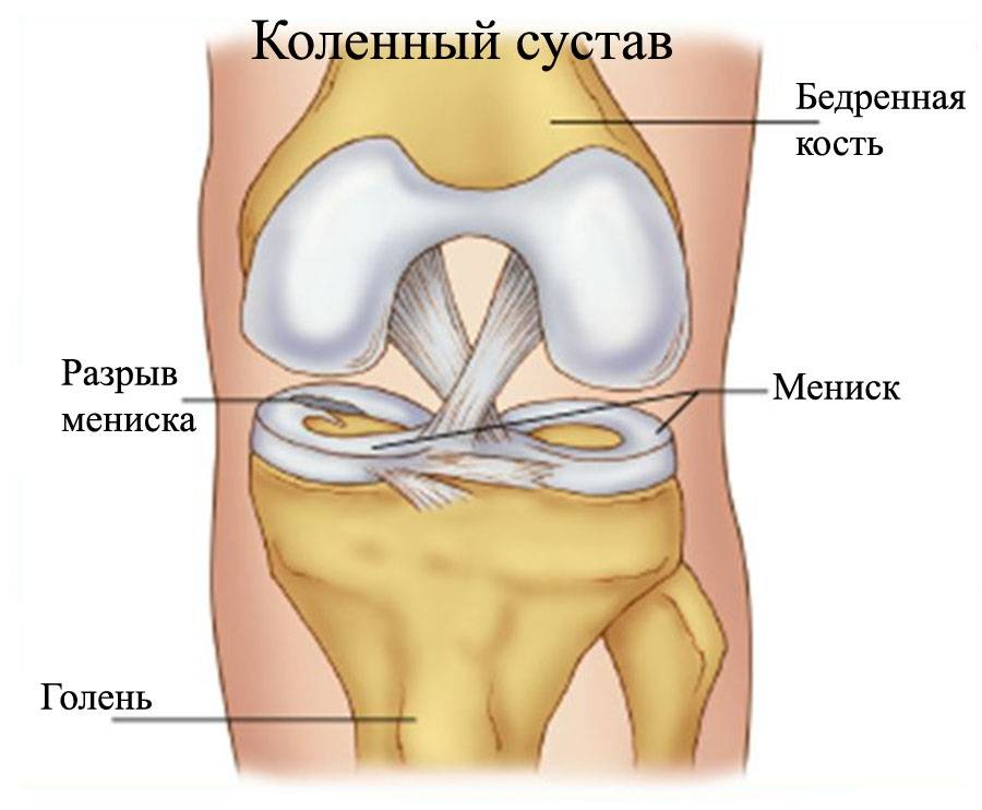 meniscus-tear_razryiv-meniska