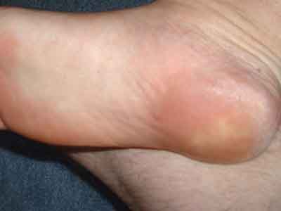 причины вознкикновения пяточной шпоры причины пяточной шпоры