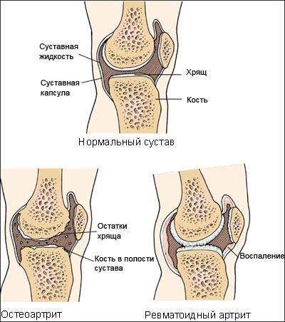 ревматоидный артрит фото: ревматоидный артрит