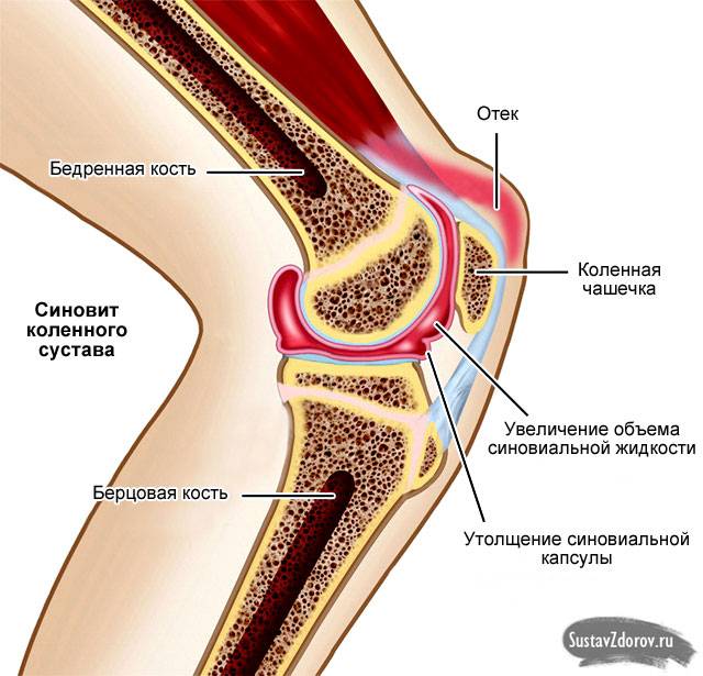 синовит коленного сустава