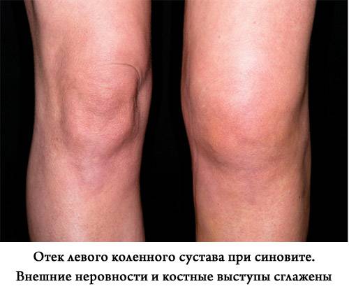 отек коленного сустава при синовите