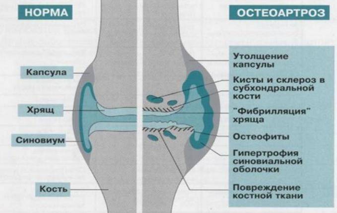 Здоровое сочленение и остеоартроз коленного сустава Остеоартроз коленного сустава