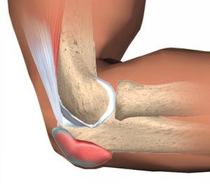 Бурсит локтя