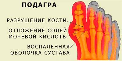 Схема: подагра разрушение кости